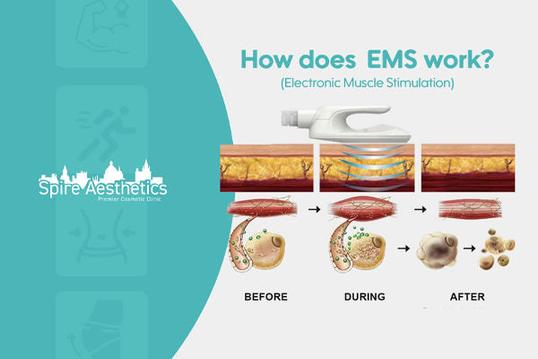 EMS treatment for post pregnancy weight loss treatment Sutton Coldfield