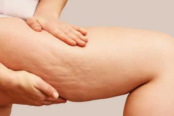 Image of woman showing leg with cellulite Sutton Coldfield