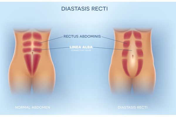What Non-Surgical Options Are Available for Diastasis Recti Sutton Coldfield?