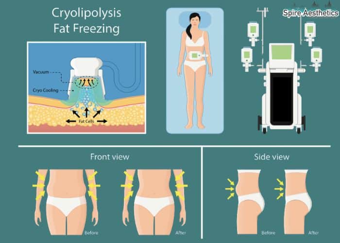 Image of diet and fat freezing combined for best results for Spire Aesthetics Sutton Coldfield