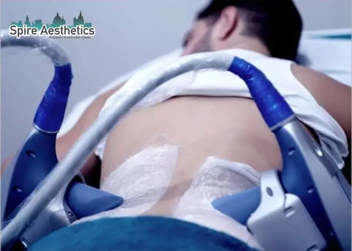 Man having fat freezing treatment done on love handles before a competitions Sutton Coldfield to create a sculpted look.
