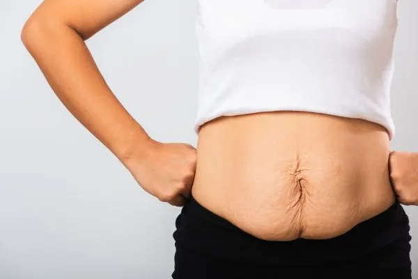 Image of a woman's stomach after weight loss with sagging skin following a gastric band Sutton Coldfield