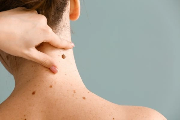 skin blemish removal Sutton Coldfield treatment
