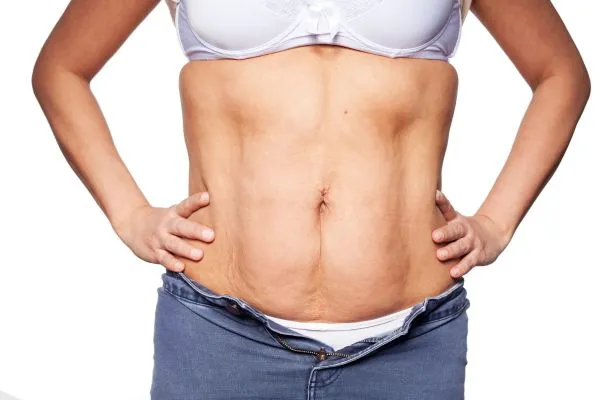sagging skin on woman's stomach after weight loss injections Sutton Coldfield