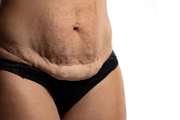 Image of womans stomach after weight loss injections Sutton Coldfield showing saggy skin