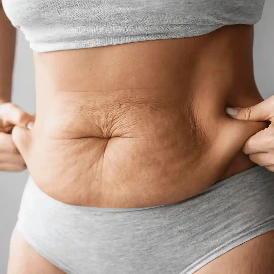 Is It Normal to Have Loose Skin After Pregnancy Sutton Coldfield?