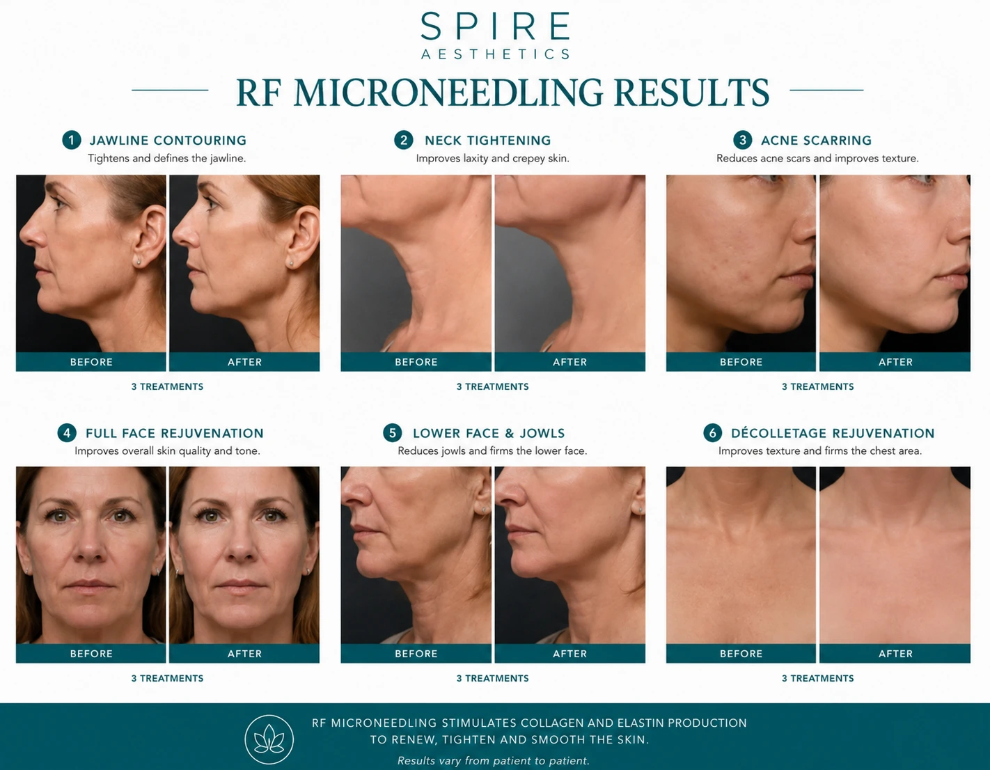 RF Microneedling Skin tightening Sutton Coldfield results