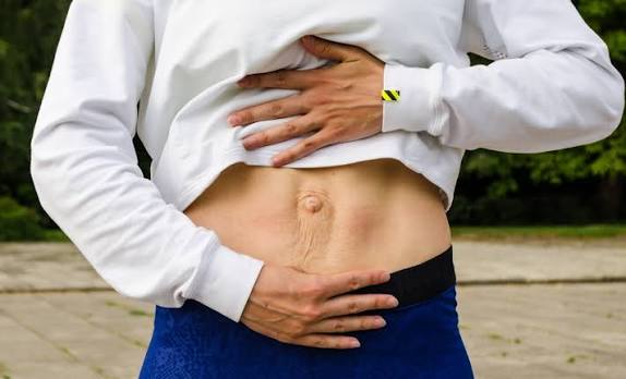 When Could Diastasis Recti Be the Missing Piece of the Puzzle Sutton Coldfield?