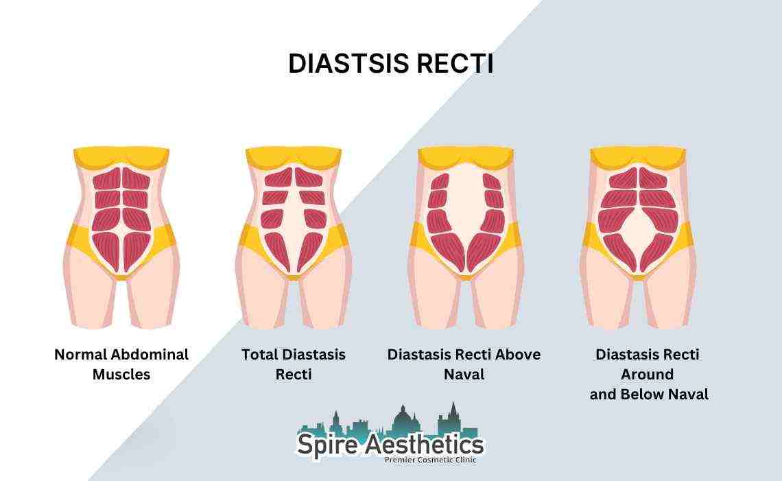Is Non-Surgical Diastasis Recti Treatment Right for You? Common Concerns Answered Sutton Coldfield